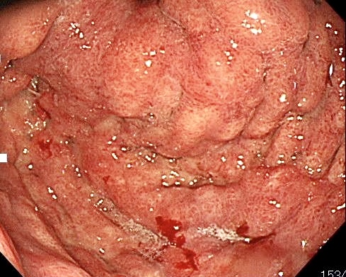 スキルス 胃がん 初期 症状 ブログ
