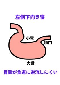 逆流性食道炎を考察する その17 知ってますか 逆流性食道炎と寝るときの姿勢 福岡天神内視鏡クリニックブログ 逆流性食道炎を考察する その17 知ってますか 逆流性食道炎と寝るときの姿勢 福岡天神内視鏡クリニックブログ