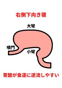 逆流性食道炎を考察する その17 知ってますか 逆流性食道炎と寝るときの姿勢 福岡天神内視鏡クリニックブログ 逆流性食道炎を考察する その17 知ってますか 逆流性食道炎と寝るときの姿勢 福岡天神内視鏡クリニックブログ