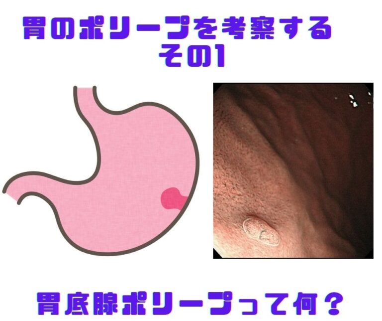 胃のポリープを考察する その1 胃底腺ポリープって何？ - 福岡天神内視鏡クリニックブログ