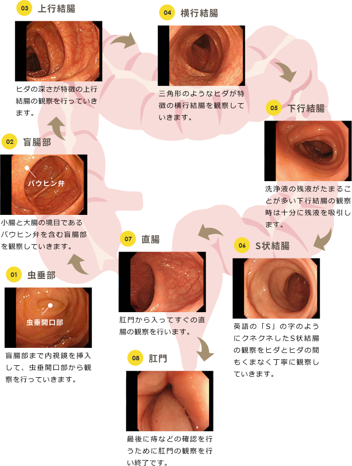 大腸カメラ検査で分かる病気