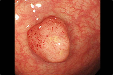 内視鏡的大腸ポリープ切除術・粘膜切除術について