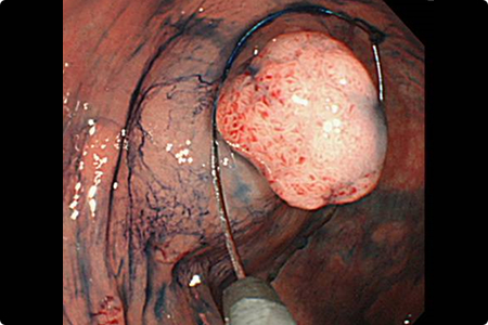 内視鏡による大腸ポリープ切除方法