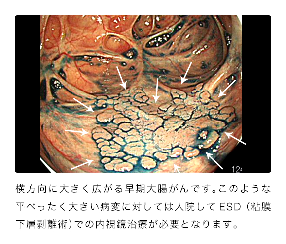 が 視 大腸 ん 鏡 手術 内