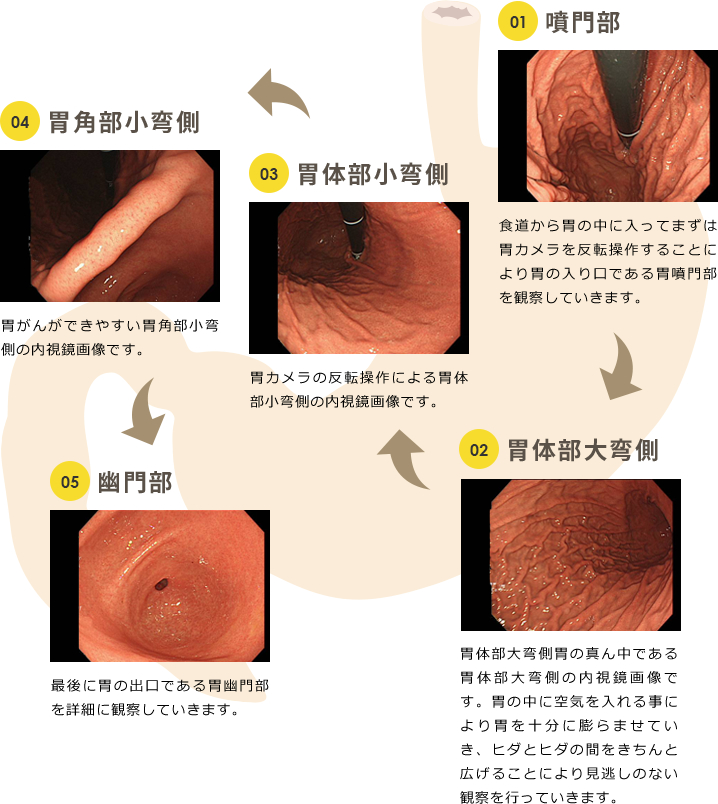 胃と十二指腸のつなぎ目（胃の出口にあたる場所です）