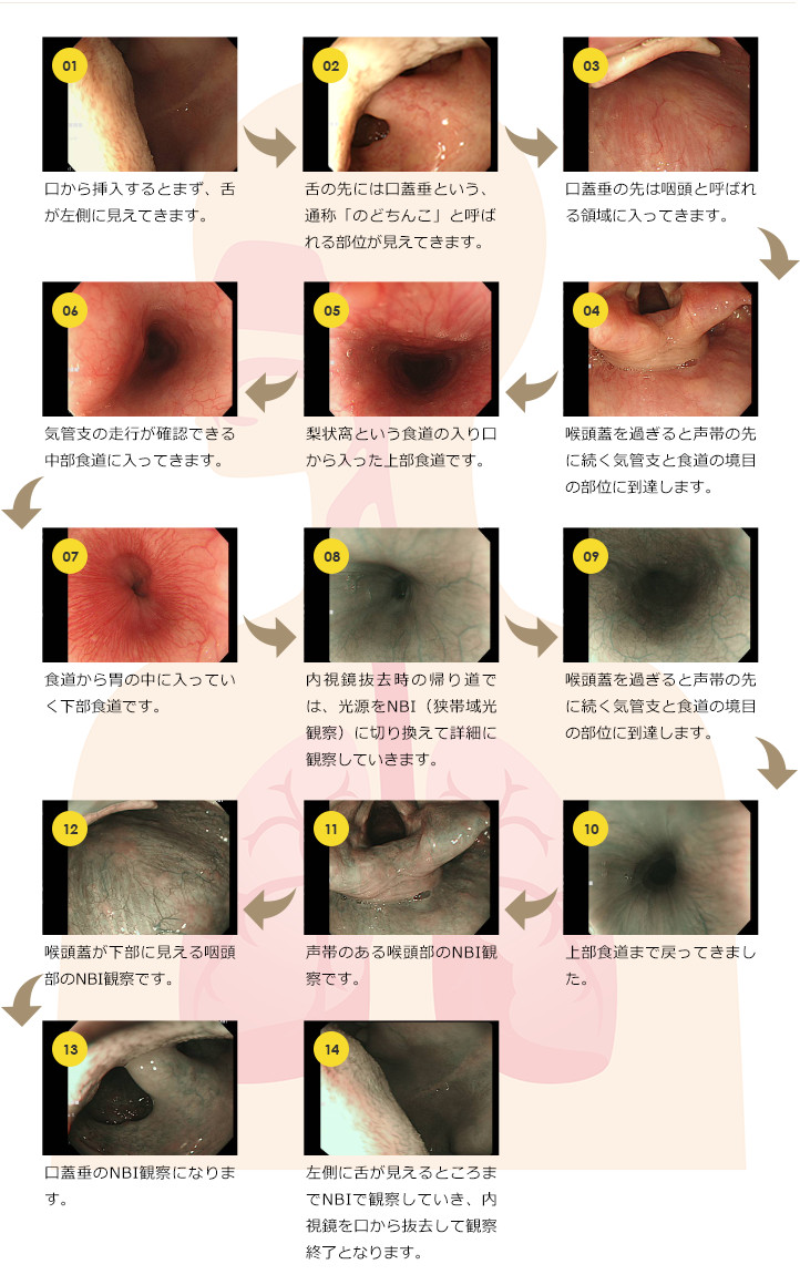 胃 内 視 鏡 検査 後 腹痛 が 続く