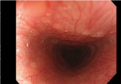 梨状窩という食道の入り口から入った上部食道です。