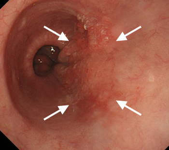胃カメラの通常光