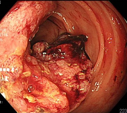 進行大腸がん