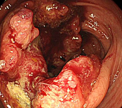 進行大腸がん