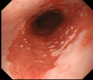 LSBE（Long Segment Barrett’s Esophagus）