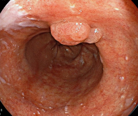 バレット食道に発生した食道腺がん