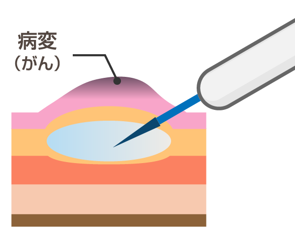 内視鏡的粘膜切除術（EMR：endoscopicmucosal resection）