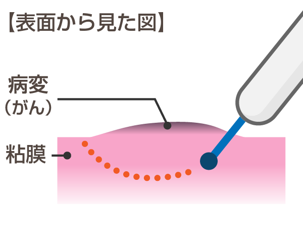 内視鏡的粘膜下層剥離術（ESD：enodoscopic submucosal dissection）