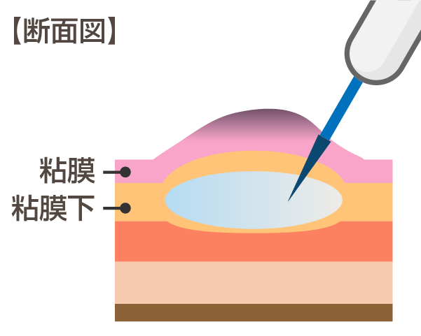 内視鏡的粘膜下層剥離術（ESD：enodoscopic submucosal dissection）