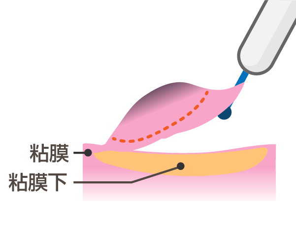 内視鏡的粘膜下層剥離術（ESD：enodoscopic submucosal dissection）