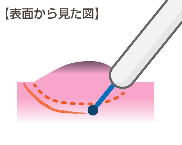 内視鏡的粘膜下層剥離術（ESD：enodoscopic submucosal dissection）