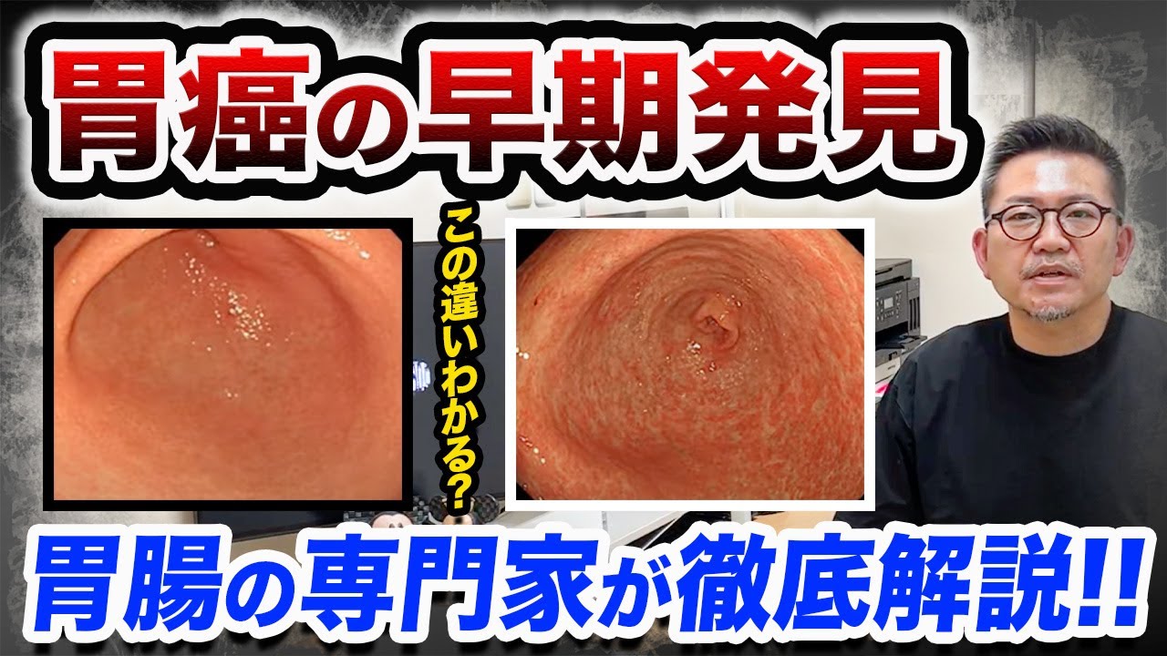 胃がんの早期発見には胃カメラで差がつく⁉️胃を切除しないためにもこの話を聞いてみてください…　教えて久津川先生